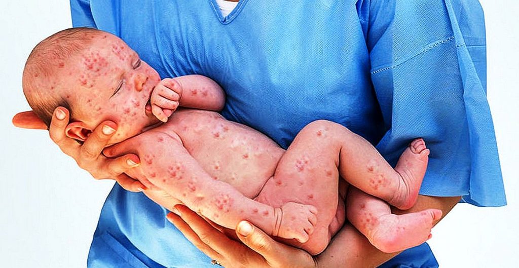 Dünyada kızamık vakaları dört kat arttı