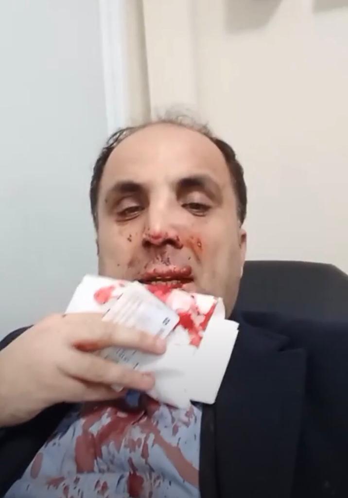 Diyarbakır’daki olaylı seçimde oda başkanının burnu kırıldı
